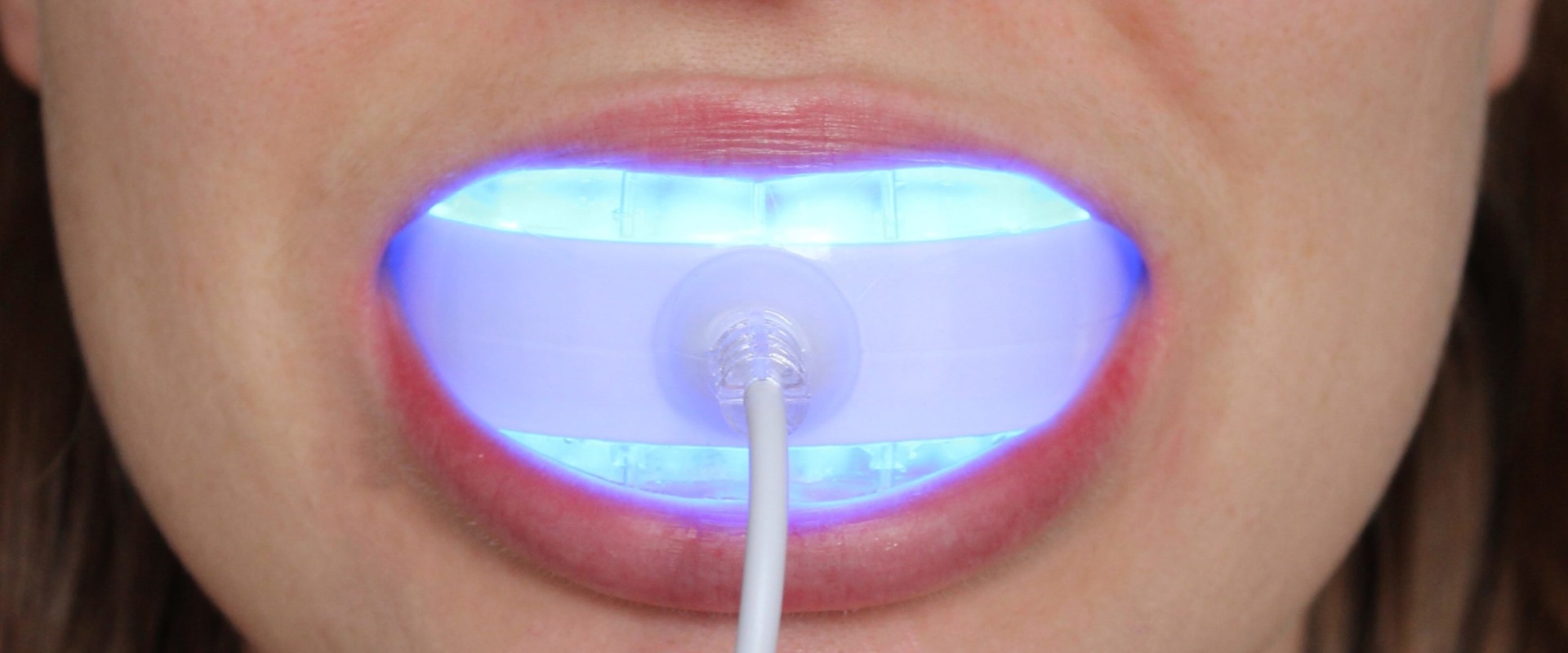 Do blue lights help whiten teeth?