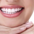 Is Teeth Whitening Permanent? A Comprehensive Guide