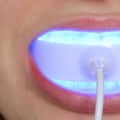 Are Teeth Whitening Lights Safe? An Expert's Perspective