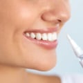 Which Teeth Whitening is Best? A Comprehensive Guide