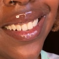 Which Teeth Whitening Pen is the Best Choice?