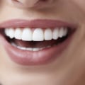 Will Teeth Whitening Damage Crowns? Expert Advice on the Topic