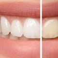 Why Teeth Whitening May Not Work