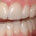 What Teeth Whitening Solutions Do Dentists Use?