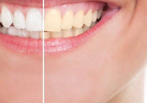 The Benefits of Teeth Whitening: A Comprehensive Guide