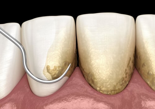 Does Teeth Whitening Remove Tartar?