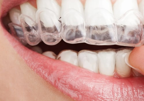 Everything You Need to Know About Teeth Whitening Strips