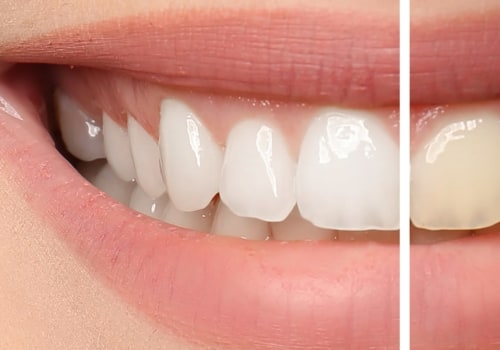 Can teeth be resistant to whitening?