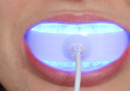 Do Blue Lights Help Whiten Teeth?