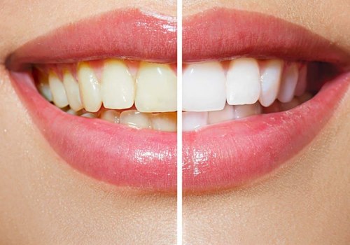 How to Achieve a Perfect White Smile with Teeth Whitening