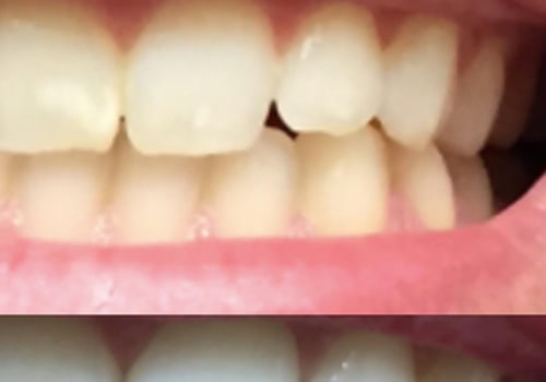 What Teeth Whitening Works Best?