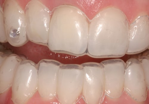 What Teeth Whitening Solutions Do Dentists Use?