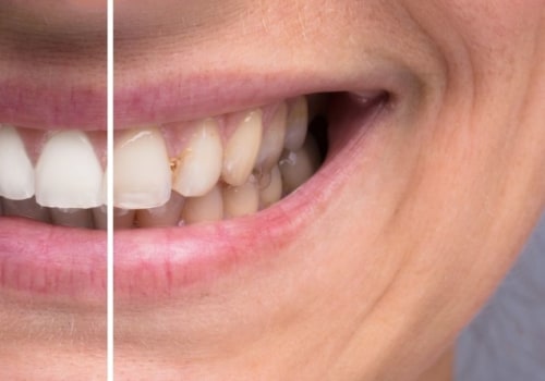 Does Teeth Whitening Cause Long-Term Damage?